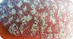 Example dry skin