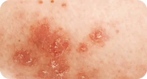 Example dry skin
